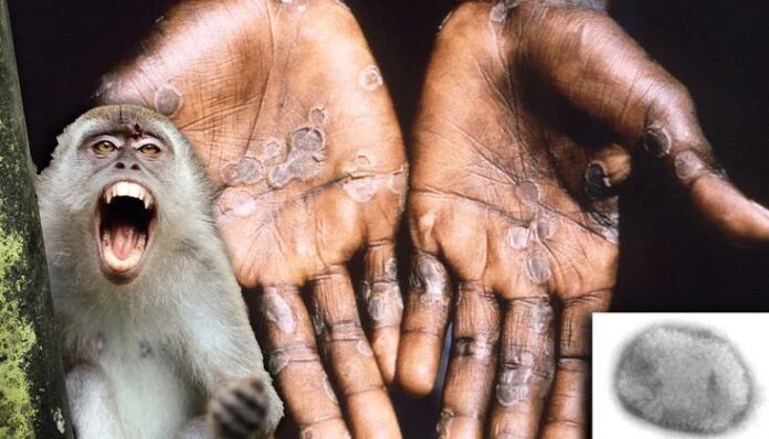 Viruela del mono: OMS convocó reunión de emergencia mientras casos aumentan
