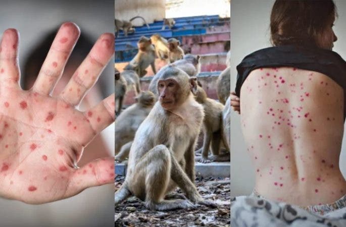 Viruela del mono ¿puede convertirse en pandemia 3 incognitas sobre