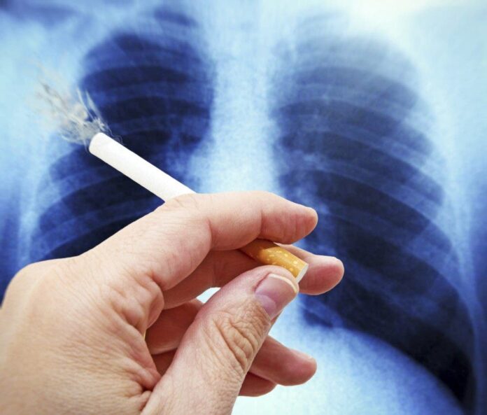 Atención tardía de cáncer de pulmón eleva muertes y costos en Latinoamérica